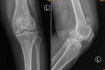 广东首例AI辅助全膝关节置换手术,手术过后就能走