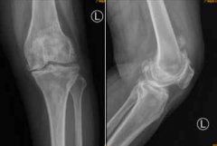 广东首例AI辅助全膝关节置换手术,手术过后就能